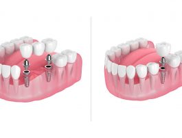 Dental Bridges Vs. Implants: Which One is the Best for You?