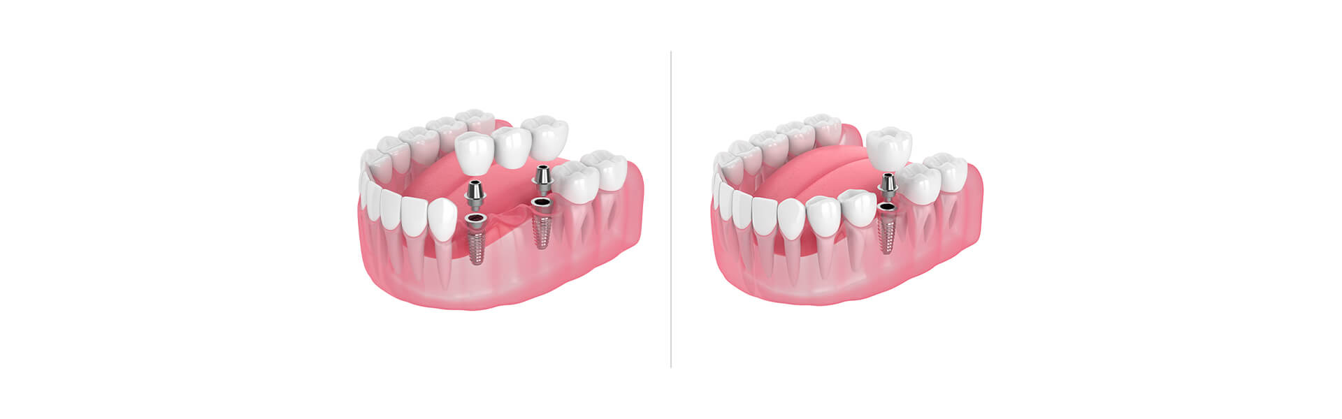 Dental Bridges Vs. Implants: Which One is the Best for You?