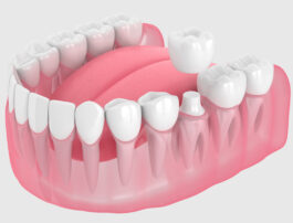 Revolutionize Your Smile: How Dental Crowns Can Transform Your Life