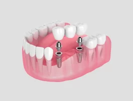 What Is the 3/2 Rule for Dental Implants?